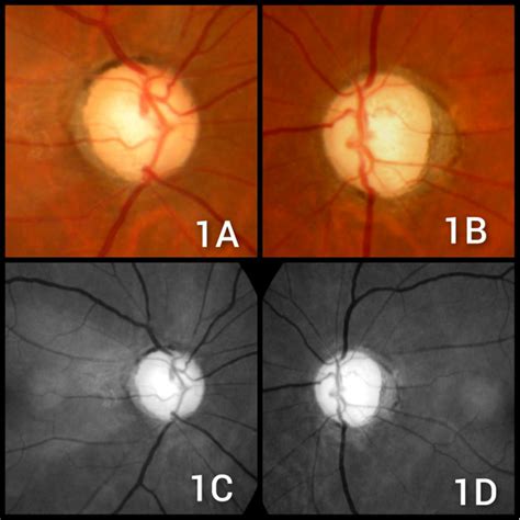 i-File: Normal Tension Glaucoma