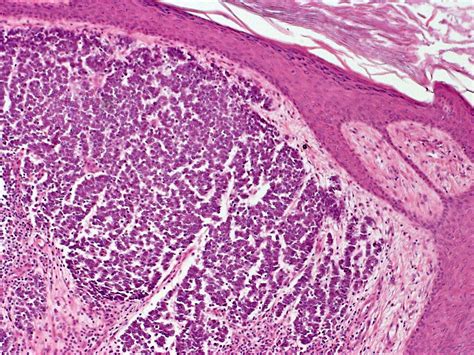 Merkel Cell Carcinoma of Skin