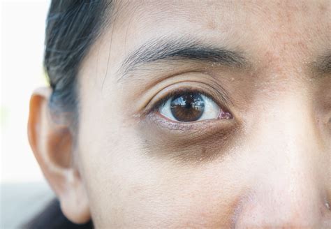 3 Treatments for periorbital dark circles | Dermatology Times