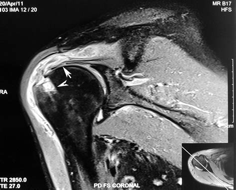 Radiodiagnosis - Imaging is Amazing-Interesting cases: Supraspinatus ...