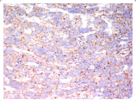 Immunohistochemical staining: Immunohistochemistry showing tumor cells ...