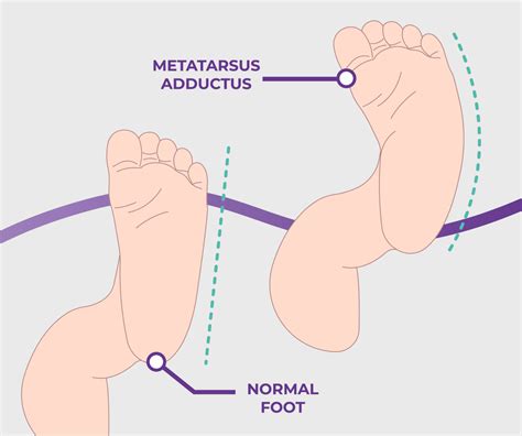 Metatarsus Adductus: Causes, Symptoms & Treatment