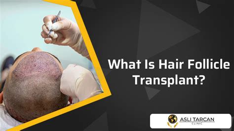 What Is Hair Follicle Transplant? | Asli Tarcan Clinic