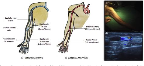 Minimally invasive basilic vein transposition in the arm or forearm for autogenous haemodialysis ...