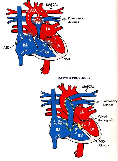 Pulmonary Atresia