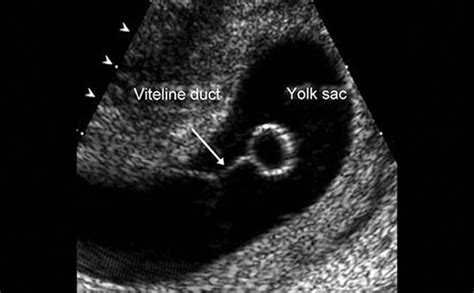 Vitelline Duct Ultrasound