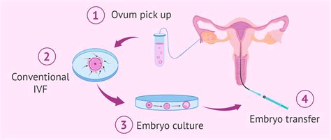 Steps in conventional IVF