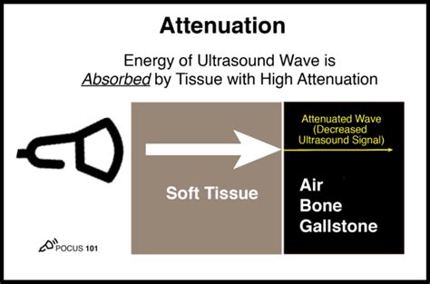 Basic Principles of Ultrasound Physics and Artifacts Made Easy - POCUS 101