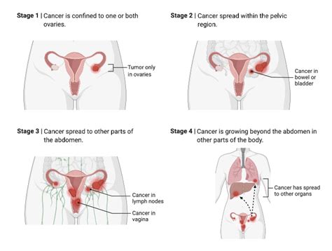 Ovarian Cancer Staging | BioRender Science Templates