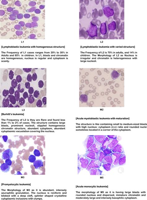 French–American–British (FAB) classification of acute myeloblastic ...