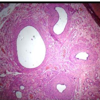 Salpingitis isthmica nodosa-glands infiltrating the wall of the... | Download Scientific Diagram