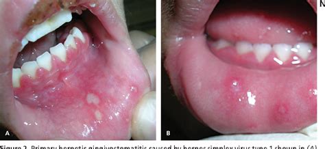 Figure 2 from Nongenital herpes simplex virus. | Semantic Scholar