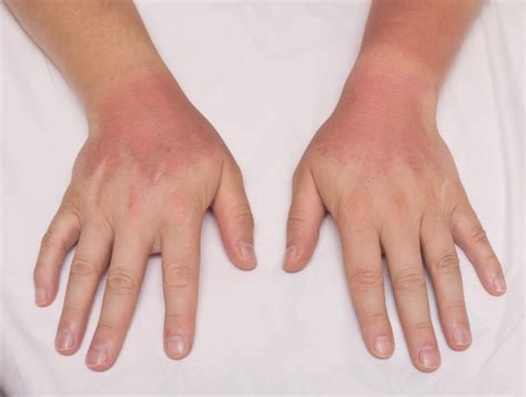 Rheumatoid Arthritis Medications & Sun Exposure - Rheumatology Advisor