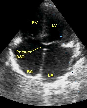 Echocardiogram in ostium primum ASD with tricuspid regurgitation – with ...