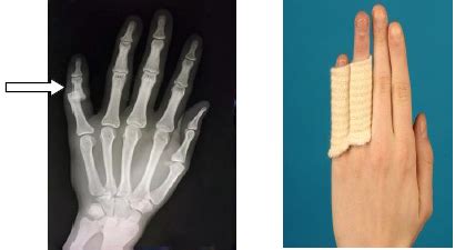 Finger dislocations | CUH