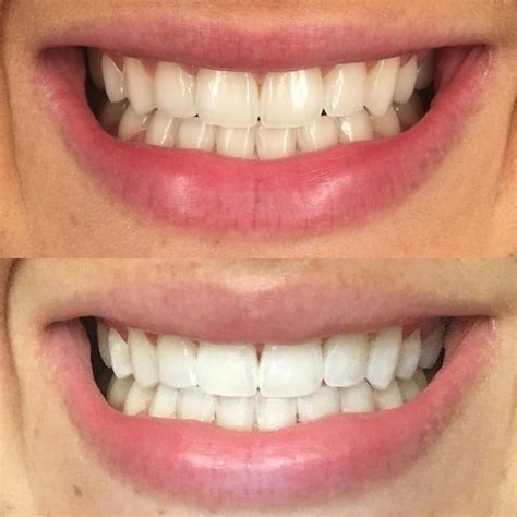 Pin on Teeth Whitening Before & After Results