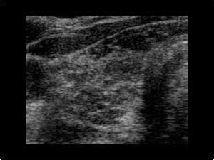 Head and Neck | 4.1 Thyroid gland : Case 4.1.4 Thyroiditis and diffuse thyroid disease ...