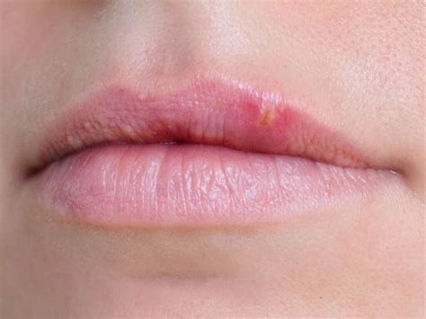 White Spots on Lips Causes, Pictures, Small, on Lower, Upper, Inside Lip - American Celiac