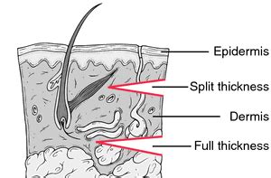 Split-thickness graft | definition of split-thickness graft by Medical dictionary