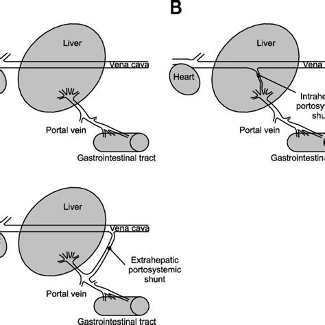 Simplified drawings illustrating types of portosystemic shunts. (A)... | Download Scientific Diagram