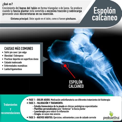 ESPOLON CALCANEO - Cirugia de Columna en Matamoros