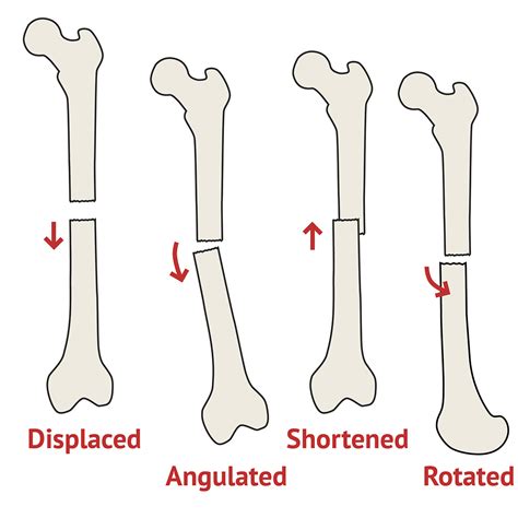 Fracture fragments meaning - lumokasin