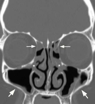 Maxillary Sinus: Abnormal