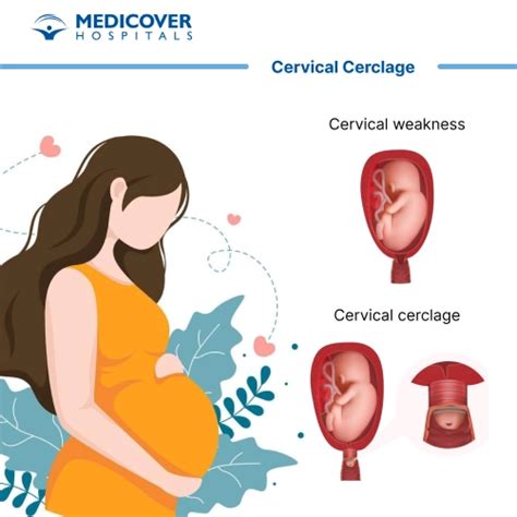 Cervical Cerclage - Indications, Procedure & Recovery