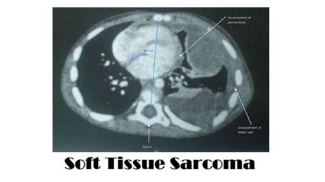 Soft Tissue Sarcoma: 7 Types, Causes, Symptoms, And Diagnosis