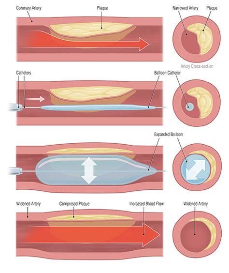 Coronary Artery Disease | Cardiovascular