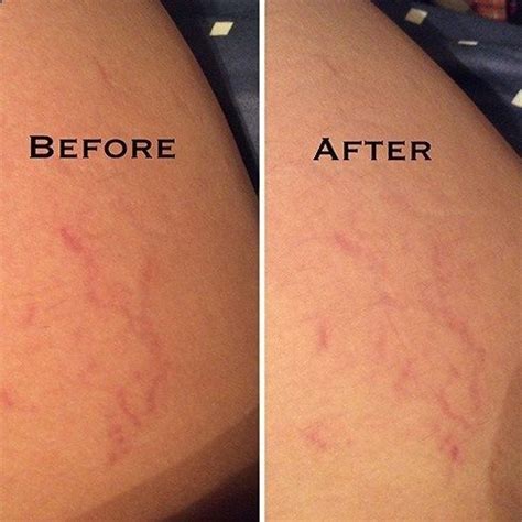 Stretch Marks www.justarganoil.... | Toile