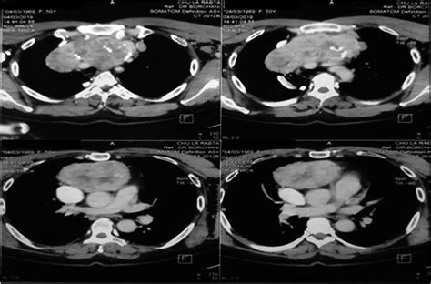 Axial CT scan section showing the anterior mediastinal mass | Download Scientific Diagram