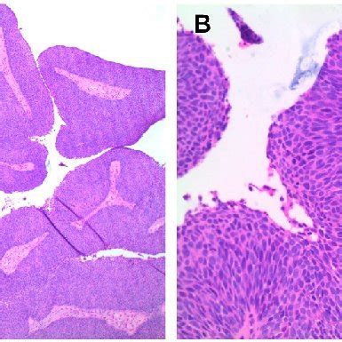 Surgical pathology of transitional cell carcinoma A. H&E, 40x. B. H&E,... | Download Scientific ...