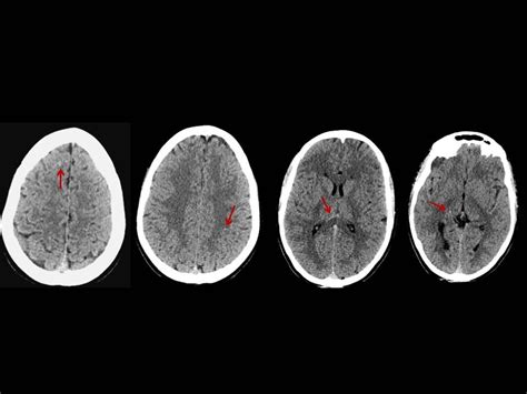 Diffuse axonal injury: CT and MRI typical findings | Eurorad