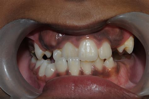 Anterior Cross Bite - Overview, Effect & Treatment