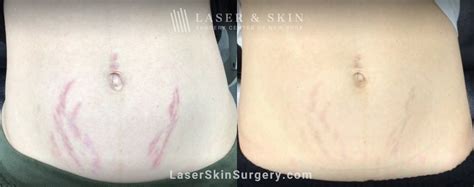 Laser Stretch Mark Removal in New York