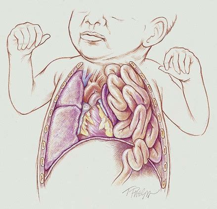 Congenital Diaphragmatic Hernia | Thoracic Key