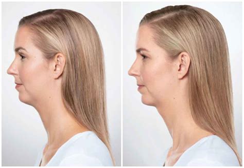 KYBELLA Before and After | Altaire Clinic