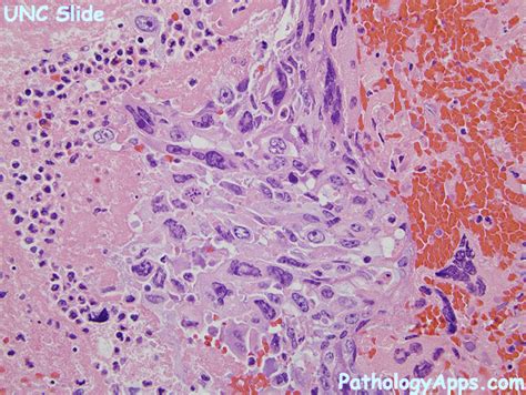 choriocarcinoma pathology