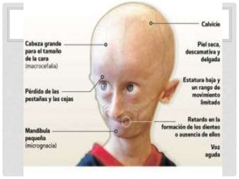 SINDROME DE HUTCHINSON-GILFORD O PROGERIA | Mind Map