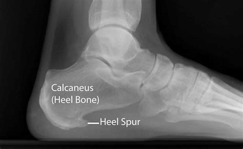 Calcaneal spur causes, symptoms, diagnosis & treatment