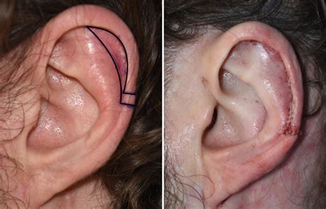 Plastic Surgery Case Study - Ear Reshaping with Vertical Height ...