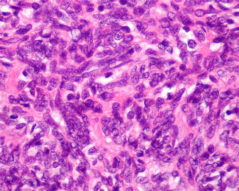 Histology; Type-A Medullary Thymoma in WHO Classification. | Download Scientific Diagram