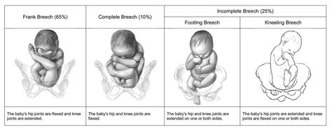 Breech Births: Why C-Section Delivery is Safer than Vaginal Delivery | Michigan Cerebral Palsy ...