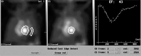 MUltiple Gated Acquisition (MUGA) scan showing left ventricular... | Download Scientific Diagram