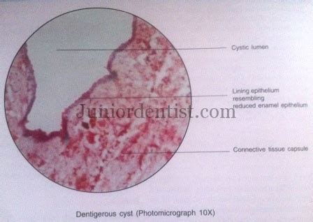 Histologic or Microscopic Features of Dentigerous Cyst | Follicular Cyst