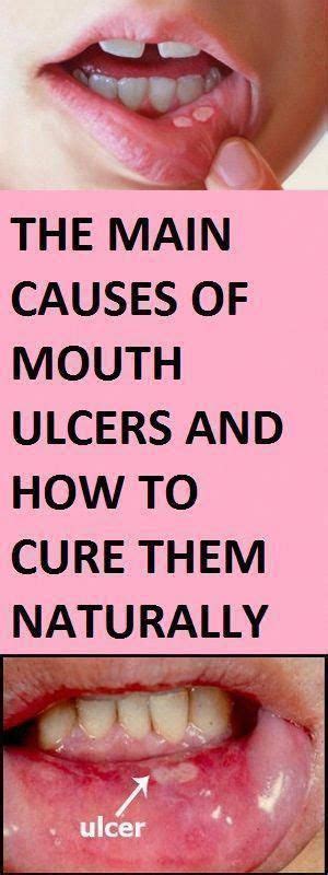 Mouth ulcers, also known as canker sores, are a common issue which is painful and also very ...