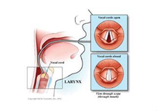 Vocal Cord Paralysis - Symptoms, Causes & Treatment