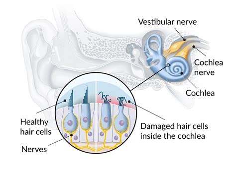 Cochlear Nerve Damage