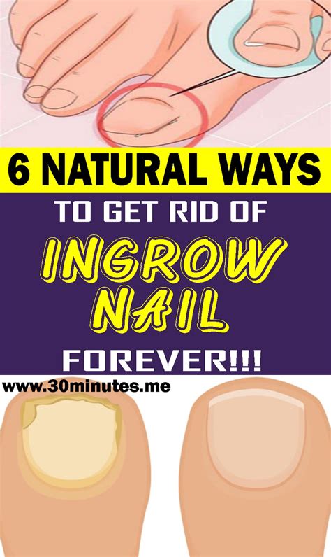 Treat Your Ingrown Toenail With These 6 Natural and Homemade Remedies